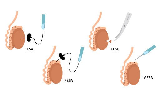 Sperm retrieval procedure